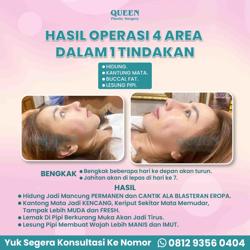Bye-Bye Pipi Chubby! Merampingkan Wajah Bulat dengan Operasi Pengangkatan Lemak Pipi