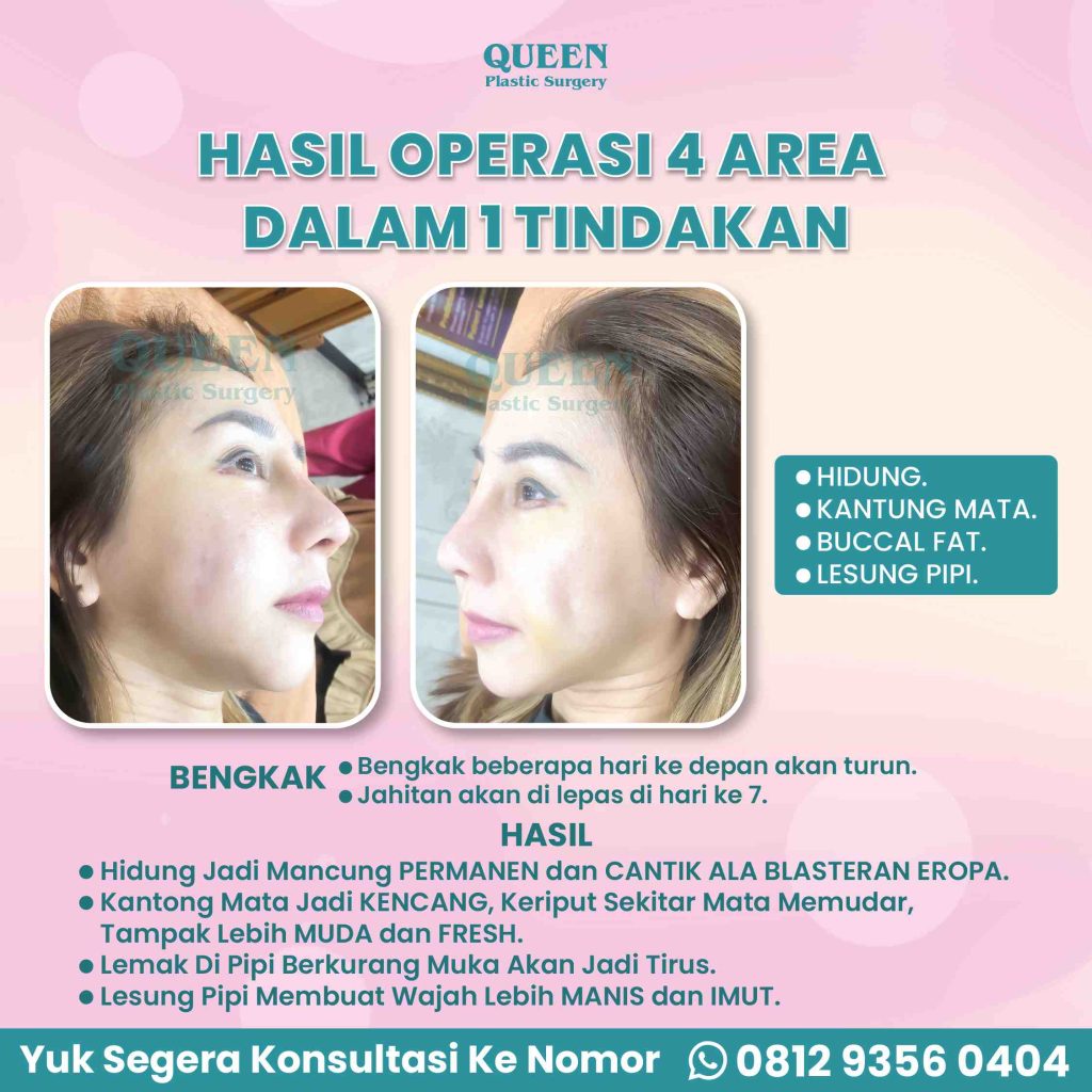 Bye-Bye Pipi Chubby! Merampingkan Wajah Bulat dengan Operasi Pengangkatan Lemak Pipi