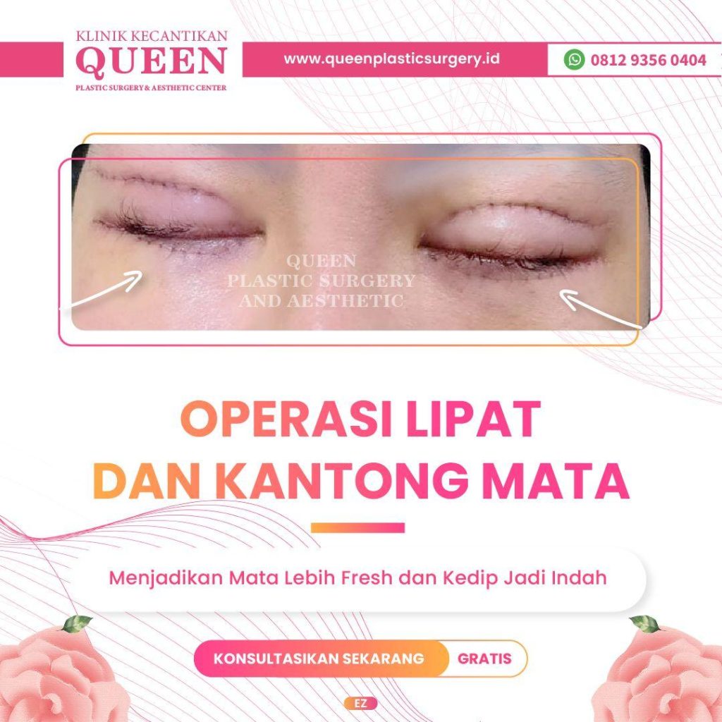 Mengenal Blepharoplasty: Jenis Operasi Pengencangan Kelopak Mata Berkerudung