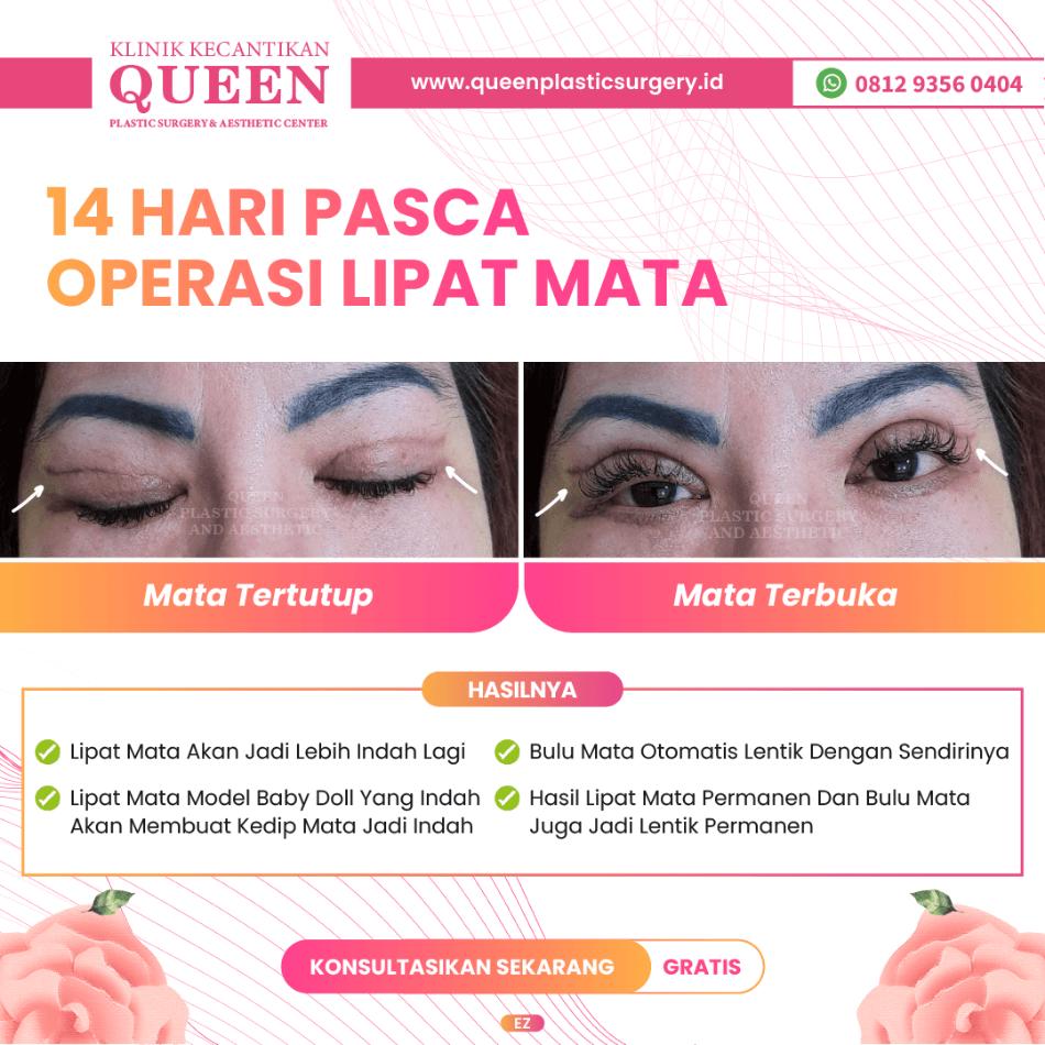 Ingin Mata Fox Eye? Simak Prosedur Bedah Terbaik untuk Hasil Alami dan Permanen