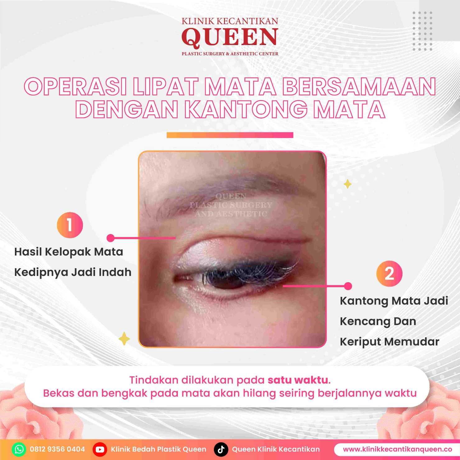 Ingin Mata Fox Eye? Simak Prosedur Bedah Terbaik untuk Hasil Alami dan Permanen