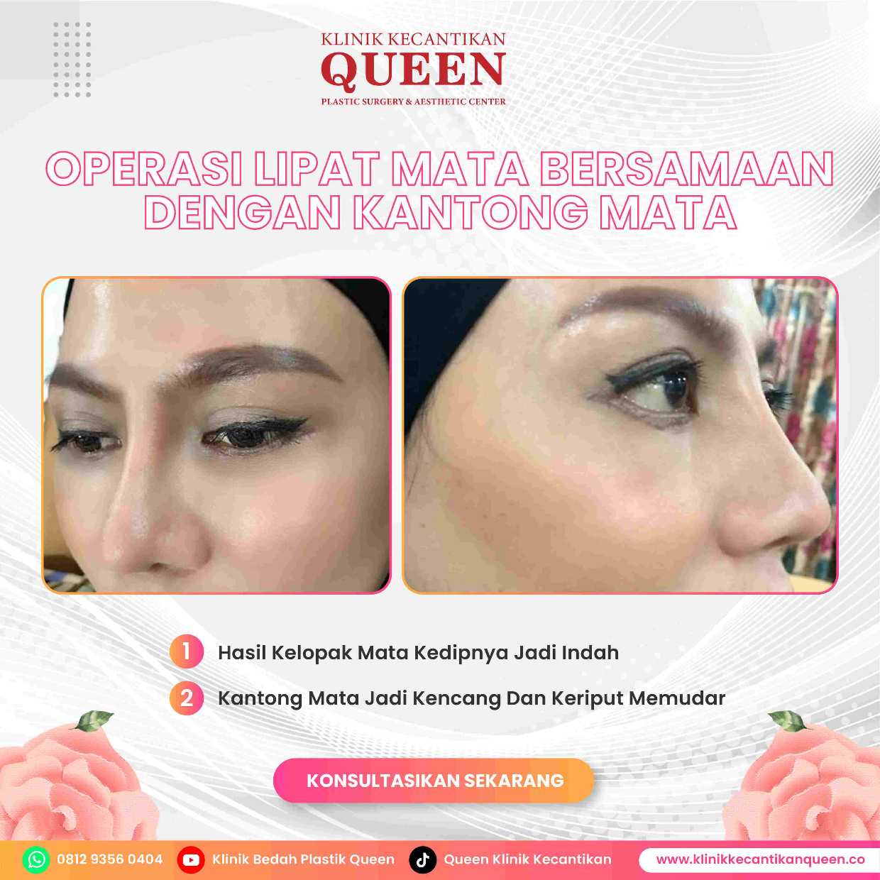 Ingin Mata Fox Eye? Simak Prosedur Bedah Terbaik untuk Hasil Alami dan Permanen