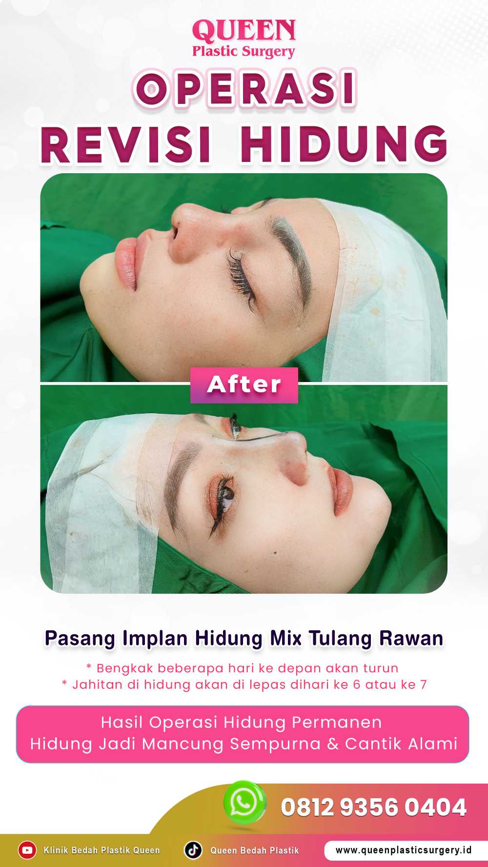 Mencari Cara Efektif Mengurangi Pembengkakan Setelah Rhinoplasty? Pelajari tentang Peran Injeksi Steroid!