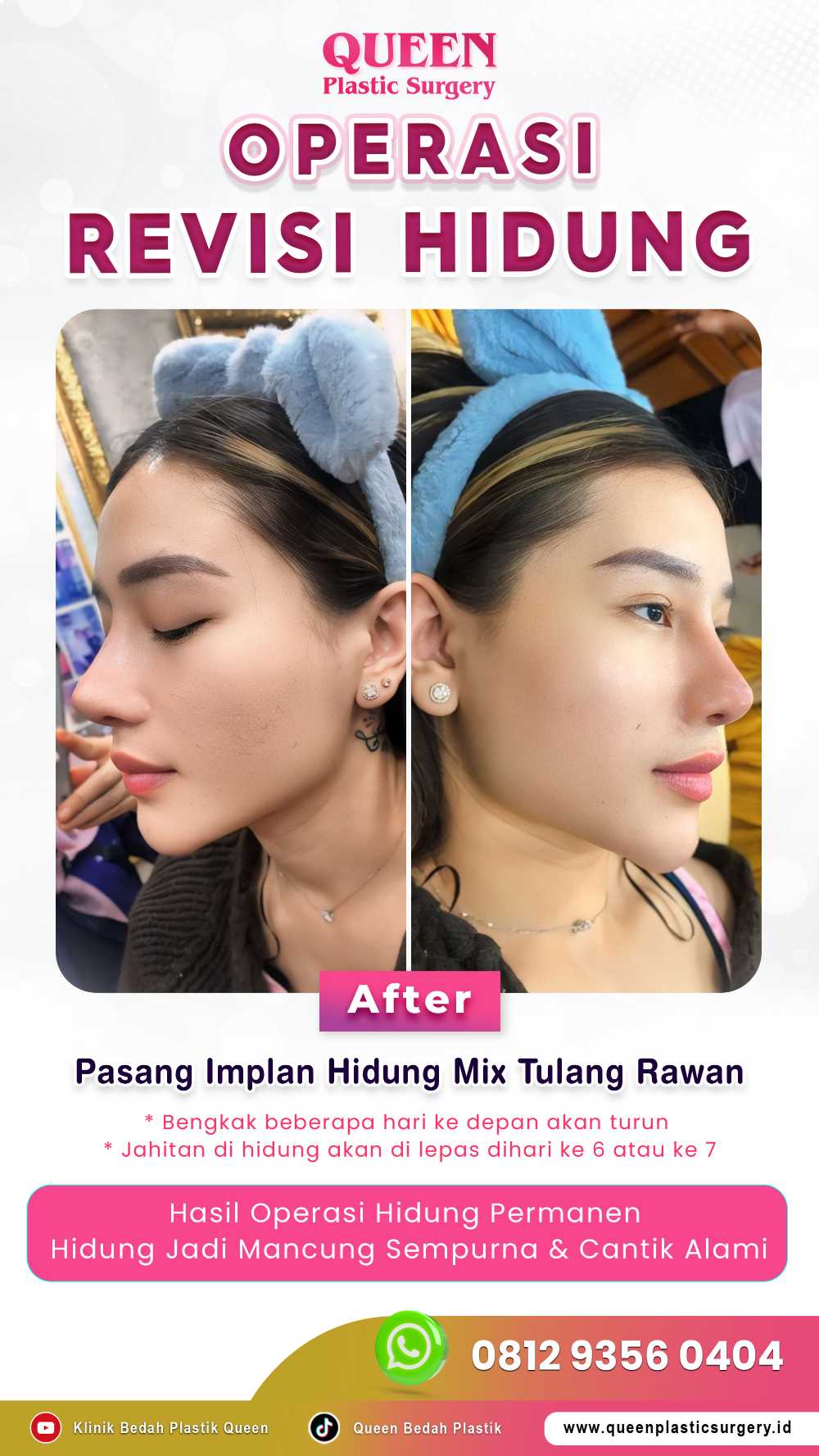 Mencari Cara Efektif Mengurangi Pembengkakan Setelah Rhinoplasty? Pelajari tentang Peran Injeksi Steroid!