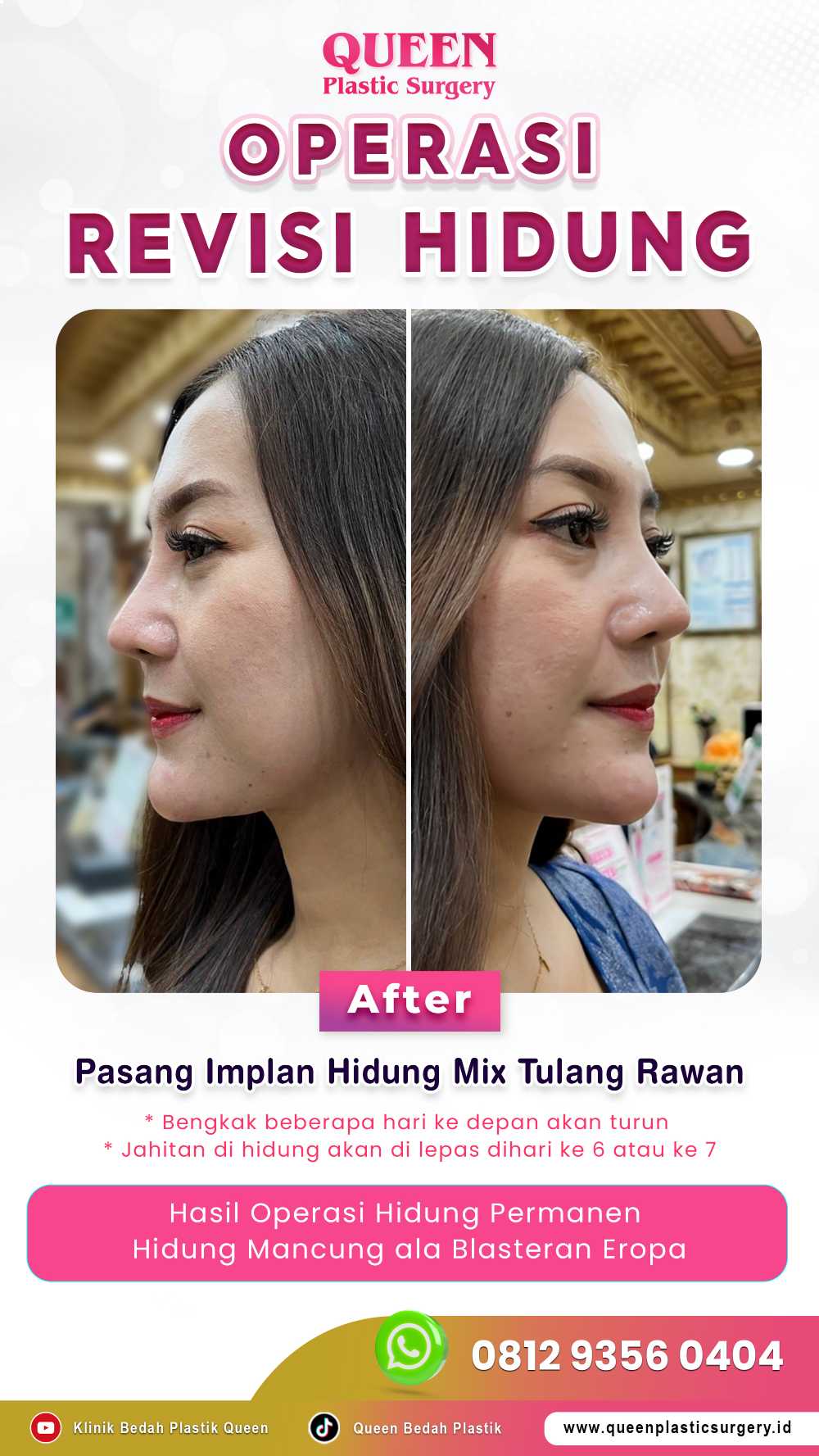 Sakit Kepala dan Nyeri Hebat Setelah Operasi Hidung? Jangan Khawatir, Ini Cara Ampuh Meredakannya!