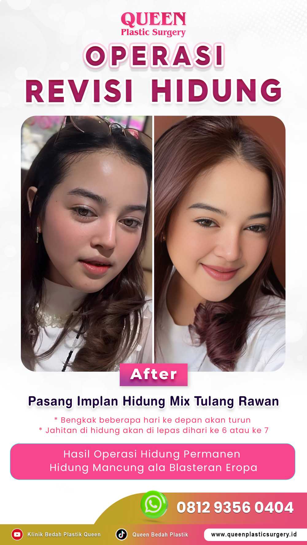 Sakit Kepala dan Nyeri Hebat Setelah Operasi Hidung? Jangan Khawatir, Ini Cara Ampuh Meredakannya!