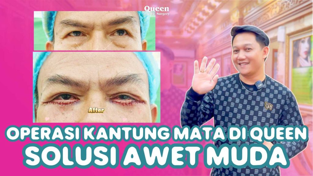Bye Kantung Mata! Kenali Berbagai Perawatan Efektif untuk Mata Lebih Segar