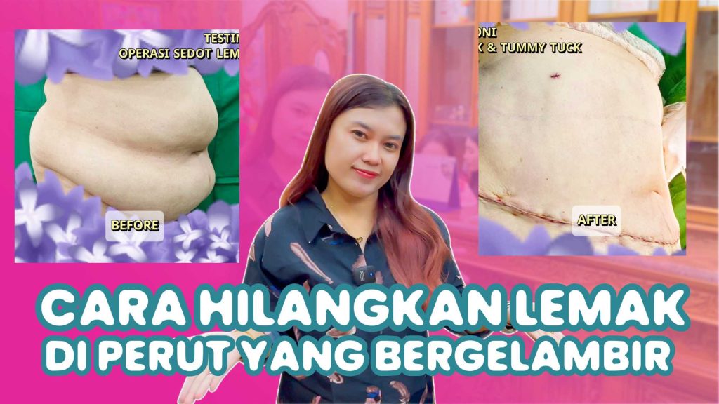 Hindari Komplikasi! Pelajari Cara Tidur yang Benar Pasca Operasi Pengencangan Perut