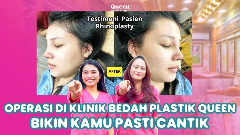 Mengapa Cangkok Tulang Rawan Sangat Penting dalam Rhinoplasty? Ini Alasannya!