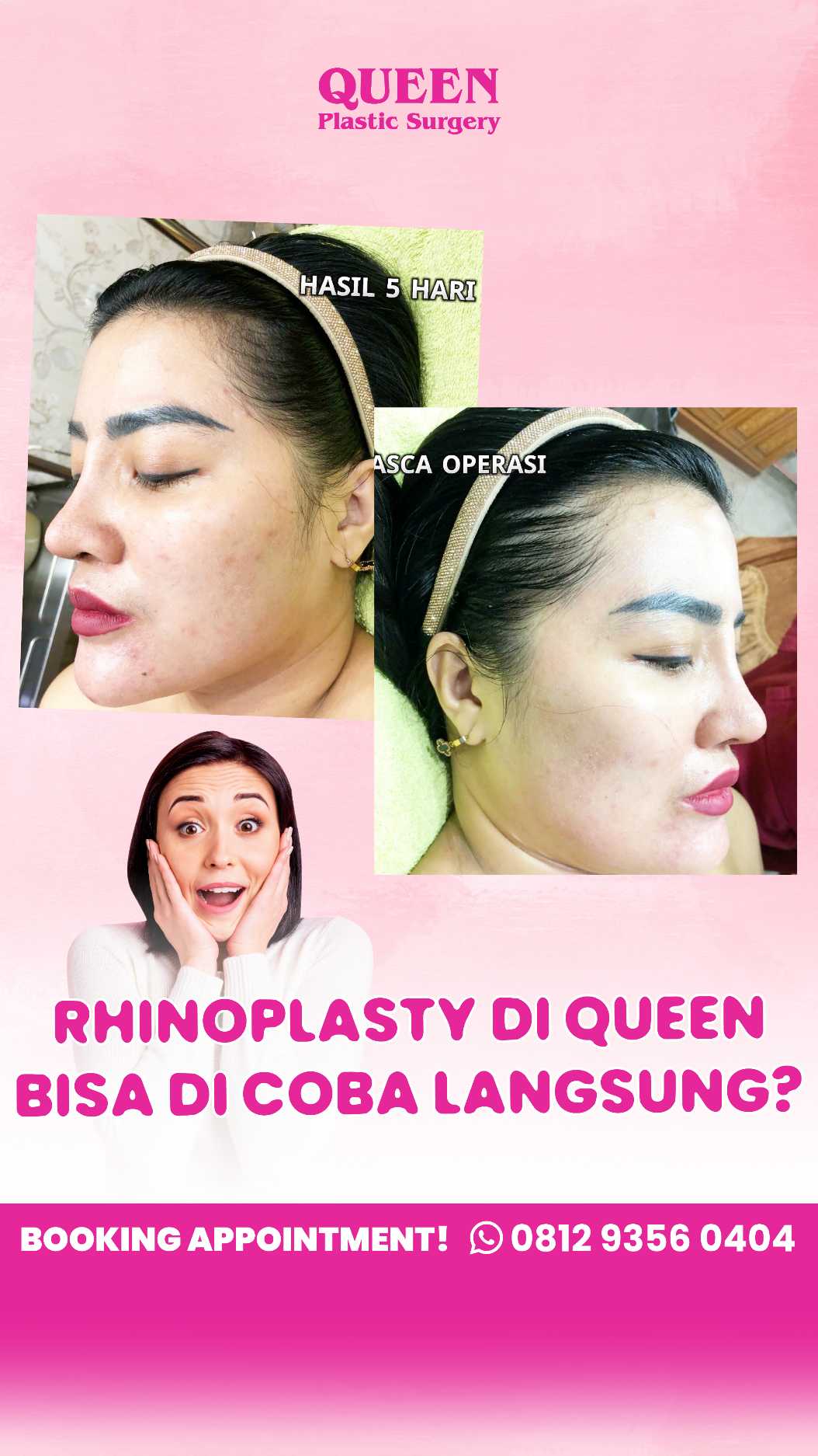 Mengapa Cangkok Tulang Rawan Sangat Penting dalam Rhinoplasty? Ini Alasannya!