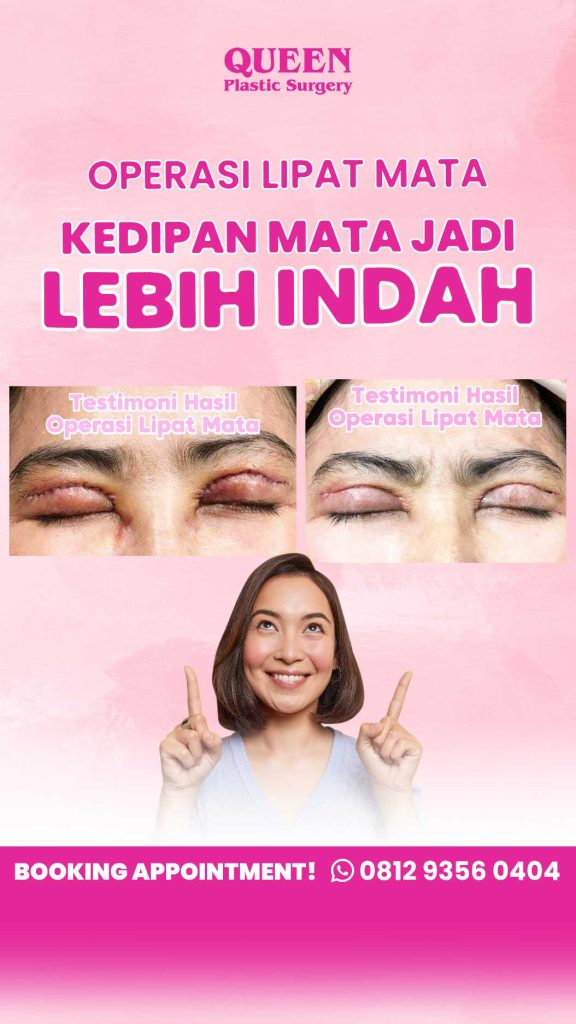 Bentuk Mata Berubah Setelah Operasi Kelopak Mata? Ini Penjelasan Lengkapnya!