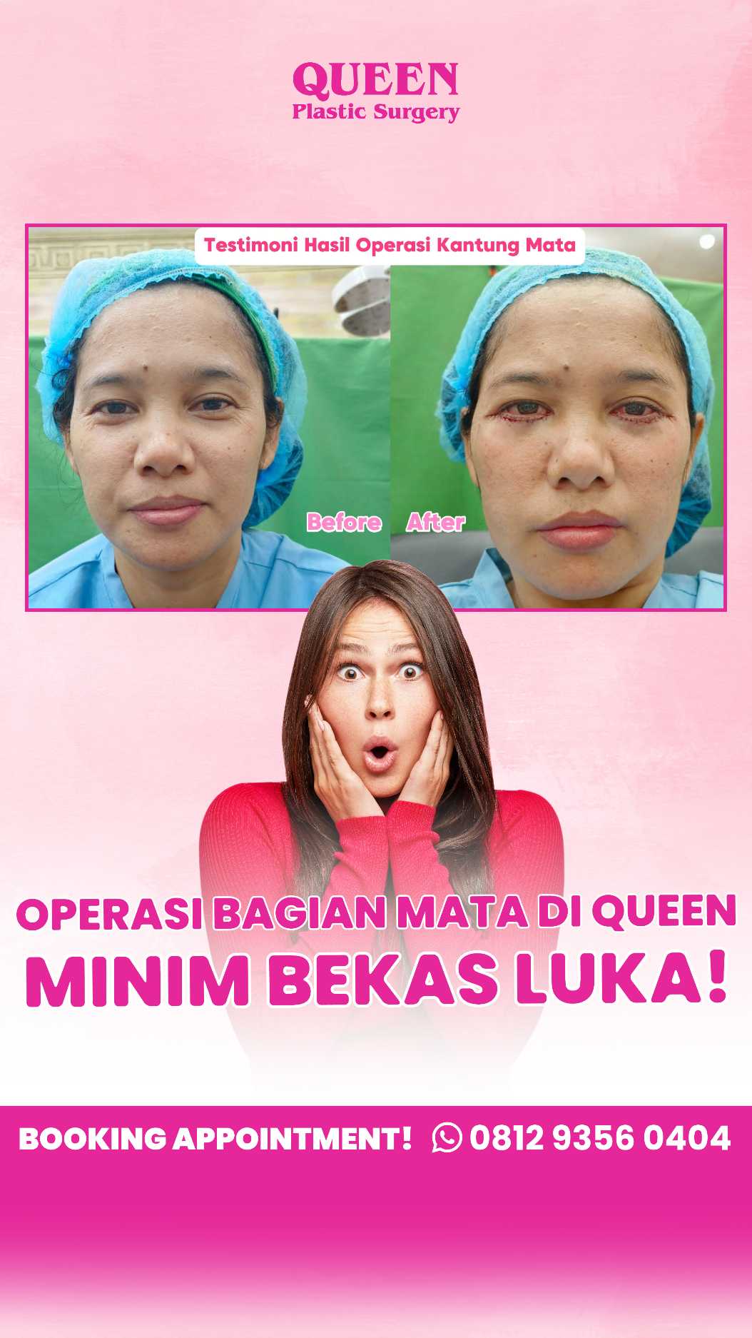 Sudah Operasi Kantung Mata Tapi Khawatir Muncul Lagi? Ini yang Perlu Anda Tahu!