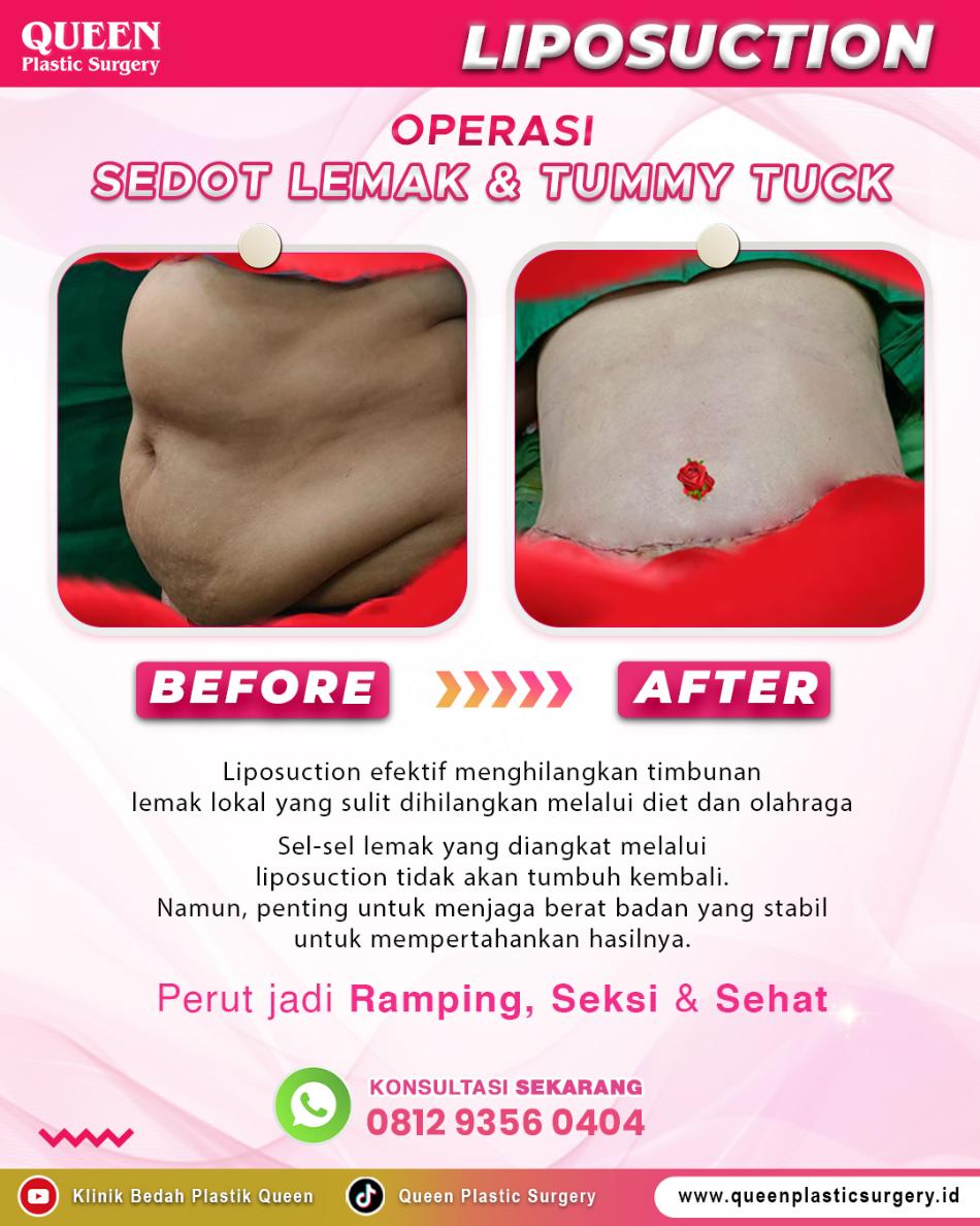 Kapan Waktu Terbaik untuk Sedot Lemak? Temukan Momen Idealmu!