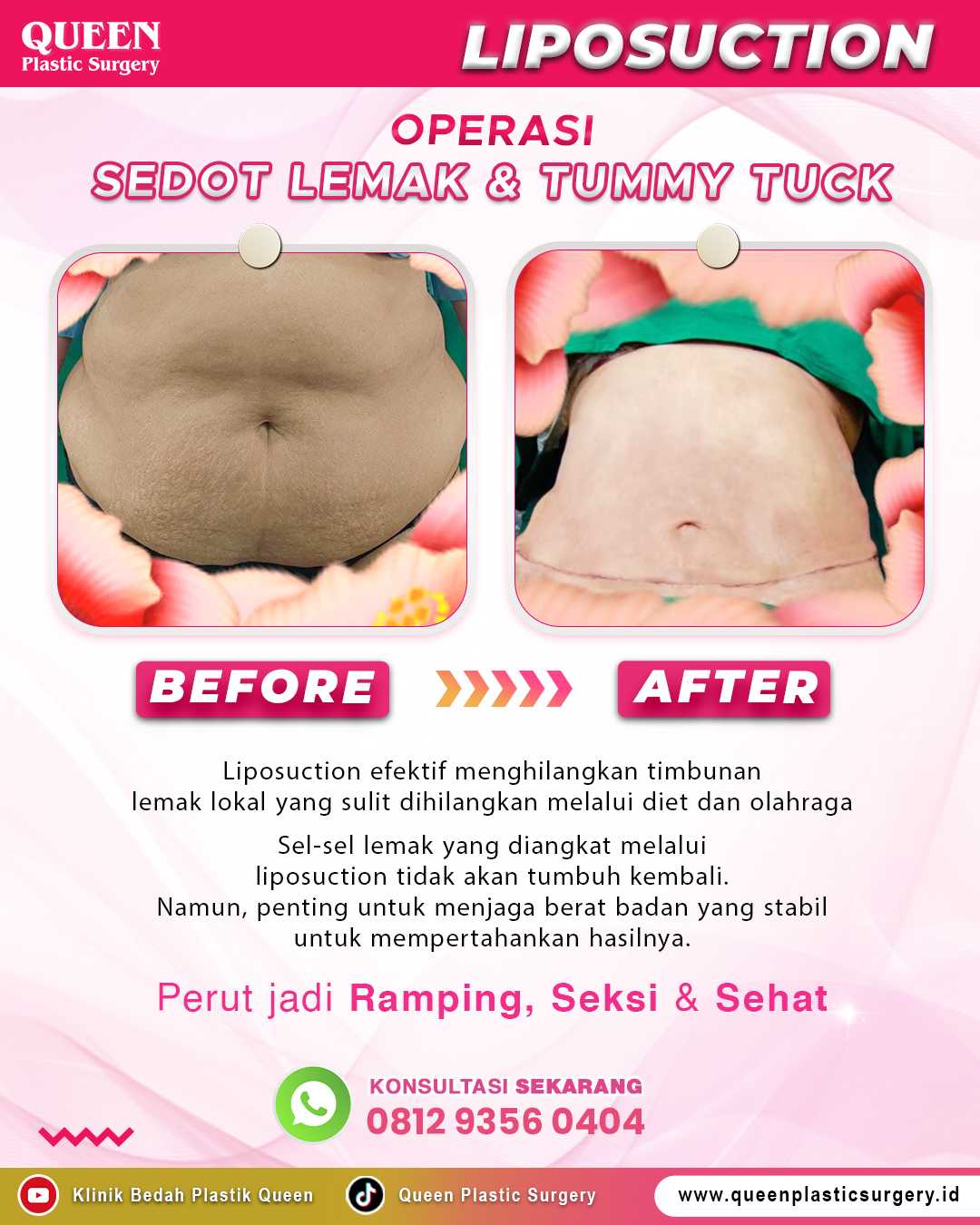 Jangan Percaya Hoax! Ini Mitos dan Fakta Seputar Mommy Makeover yang Wajib Anda Tahu
