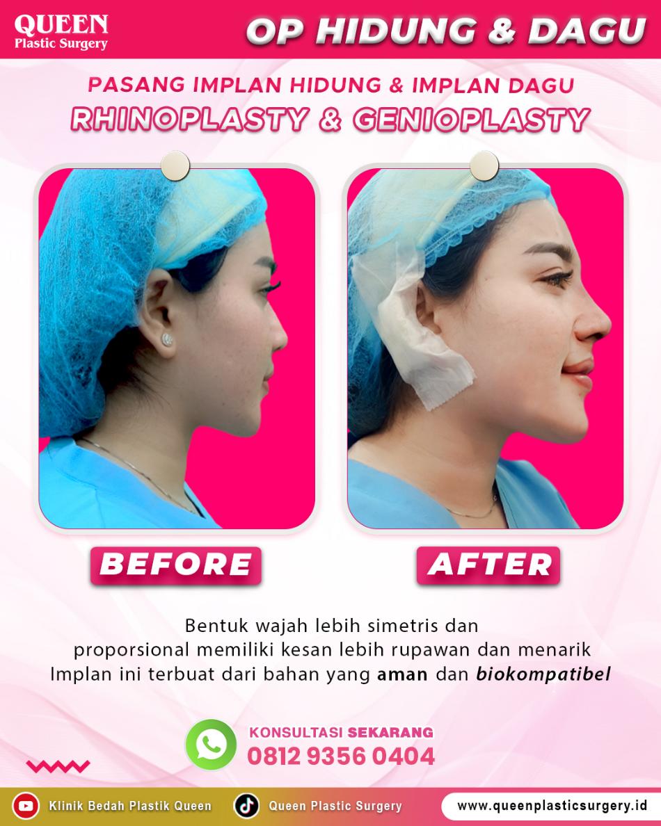 Dagu Lebih Menonjol atau Rahang Lebih Tegas? Kenali Implan Dagu vs. Implan Rahang di Sini!