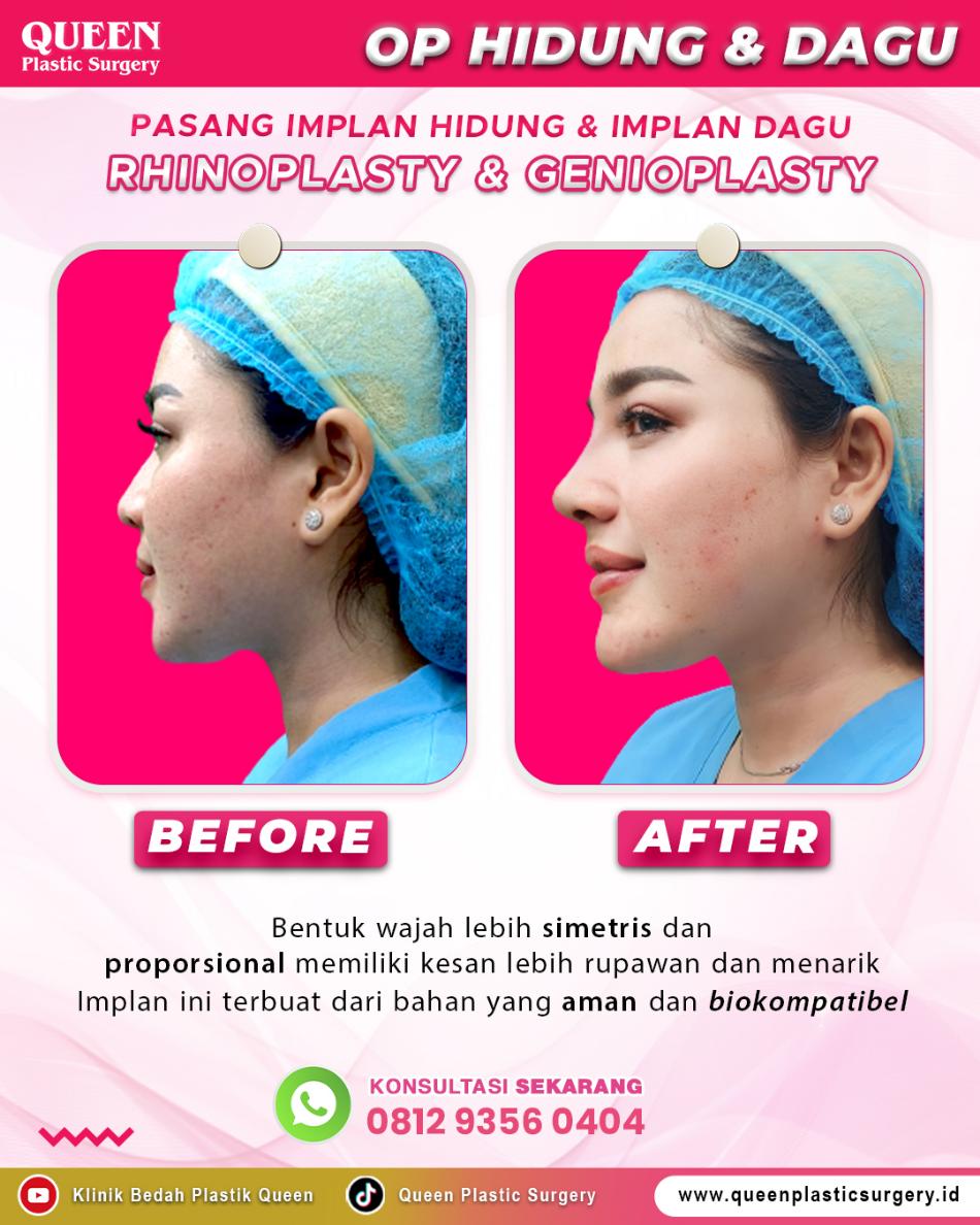 Dagu Lebih Menonjol atau Rahang Lebih Tegas? Kenali Implan Dagu vs. Implan Rahang di Sini!