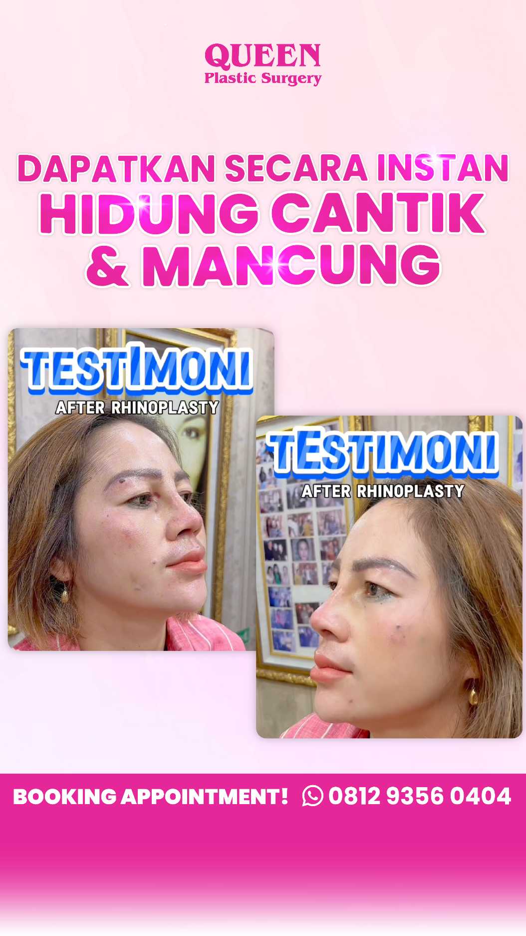 Mengapa Cangkok Tulang Rawan Sangat Penting dalam Rhinoplasty? Ini Alasannya!