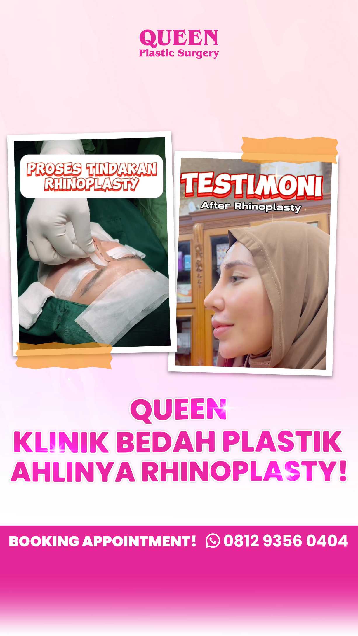 Mencari Cara Efektif Mengurangi Pembengkakan Setelah Rhinoplasty? Pelajari tentang Peran Injeksi Steroid!