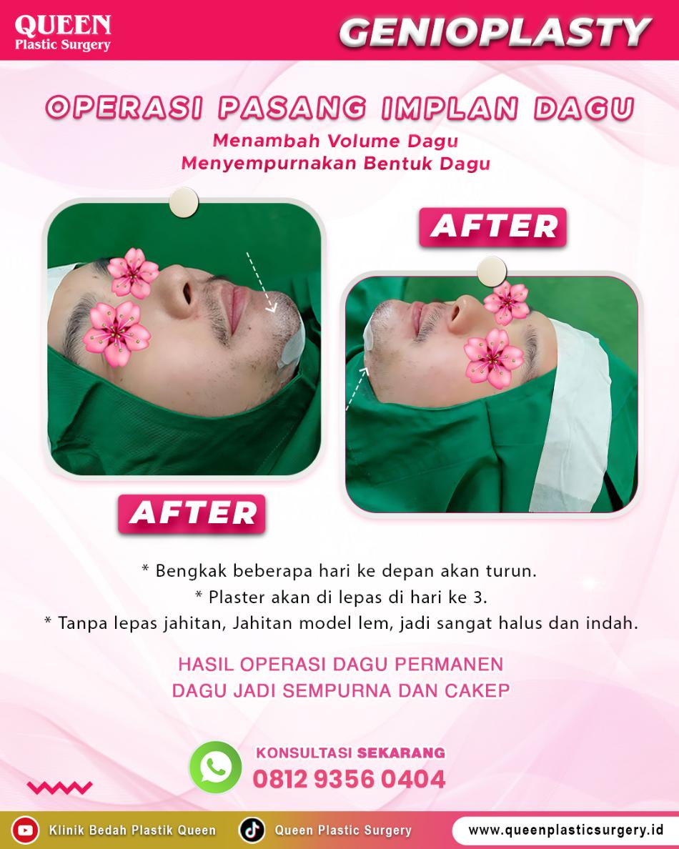 Dagu Lebih Menonjol atau Rahang Lebih Tegas? Kenali Implan Dagu vs. Implan Rahang di Sini!