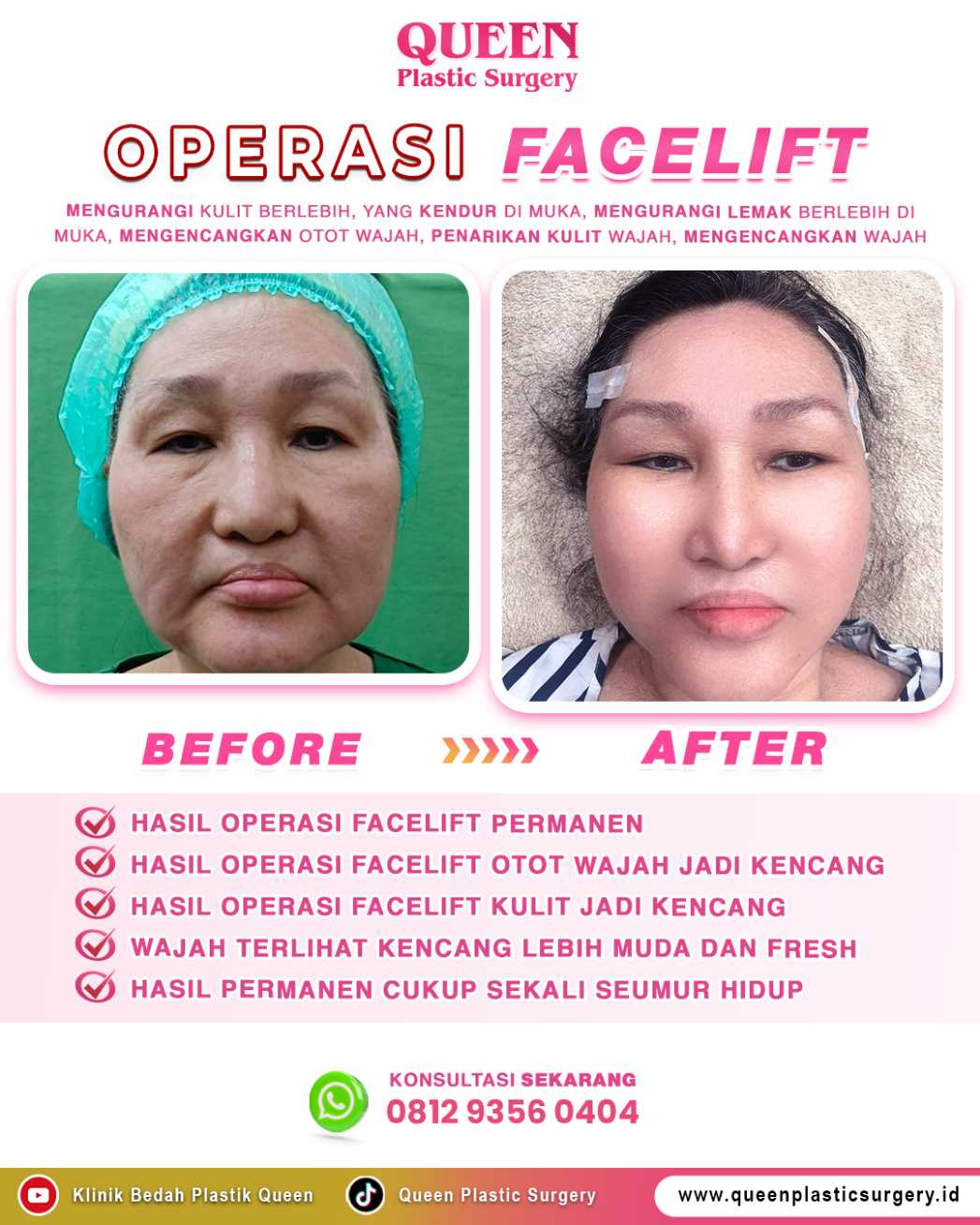 Operasi Facelift pada Pria vs. Wanita: Apa yang Membedakan Keduanya?