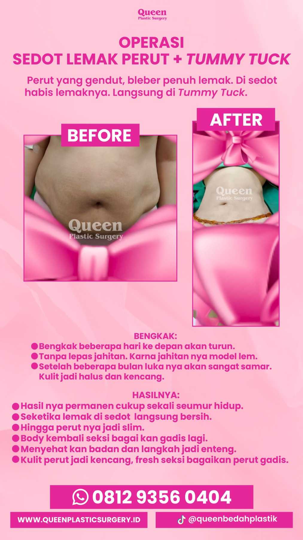 Body Contouring: Sedot Lemak Plus Prosedur Lain yang Ideal, Mulai Perubahan Anda!