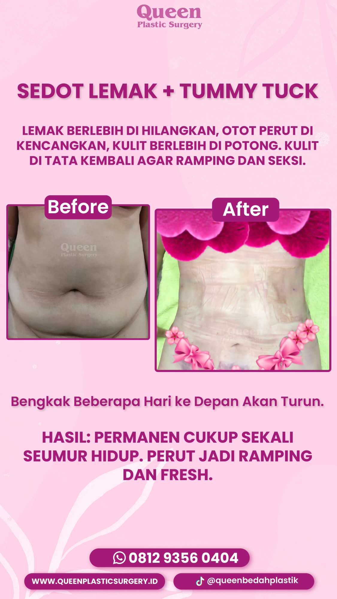 Berdiri Tegak Setelah Tummy Tuck: Kapan Waktu yang Tepat dan Bagaimana Caranya?