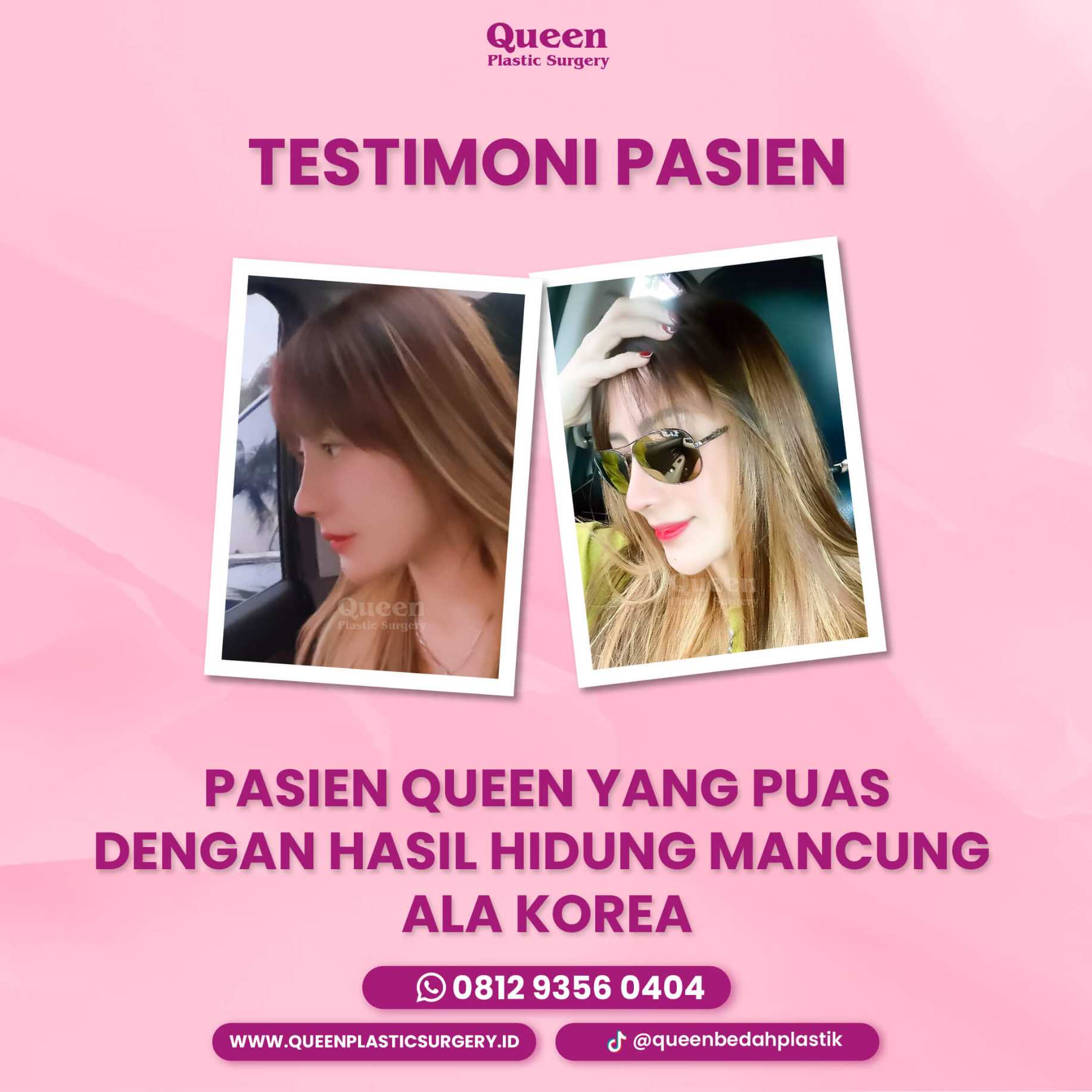 Rhinoplasty Tertutup: Operasi Minimal Invasif untuk Hidung Ideal Tanpa Bekas Luka