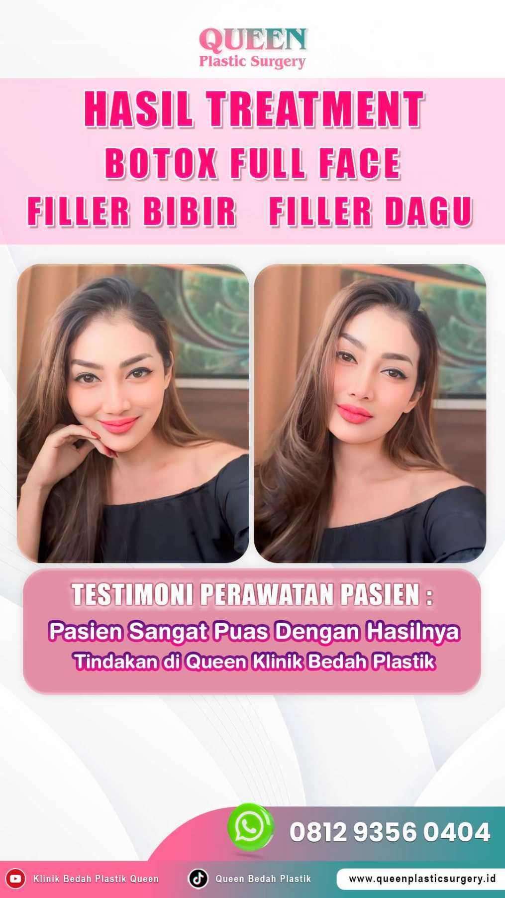 Transfer Lemak Wajah vs. Dermal Filler: Pilih Mana untuk Wajah Kencang dan Bervolume Alami?