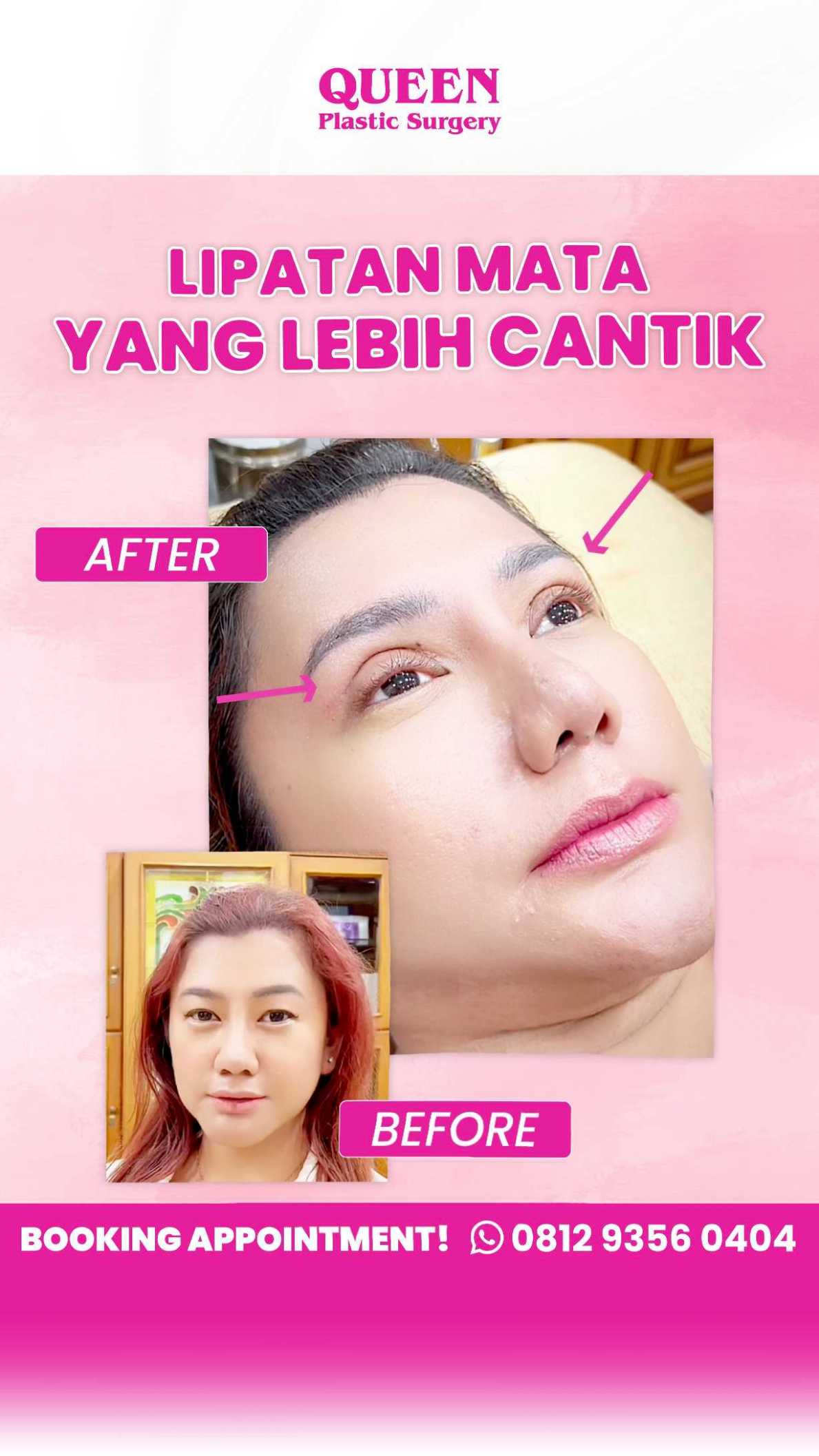 Rahasia Mata Indah Setelah Blepharoplasty: Ini Caranya Meminimalkan Tampilan Asimetri Kelopak Mata Anda