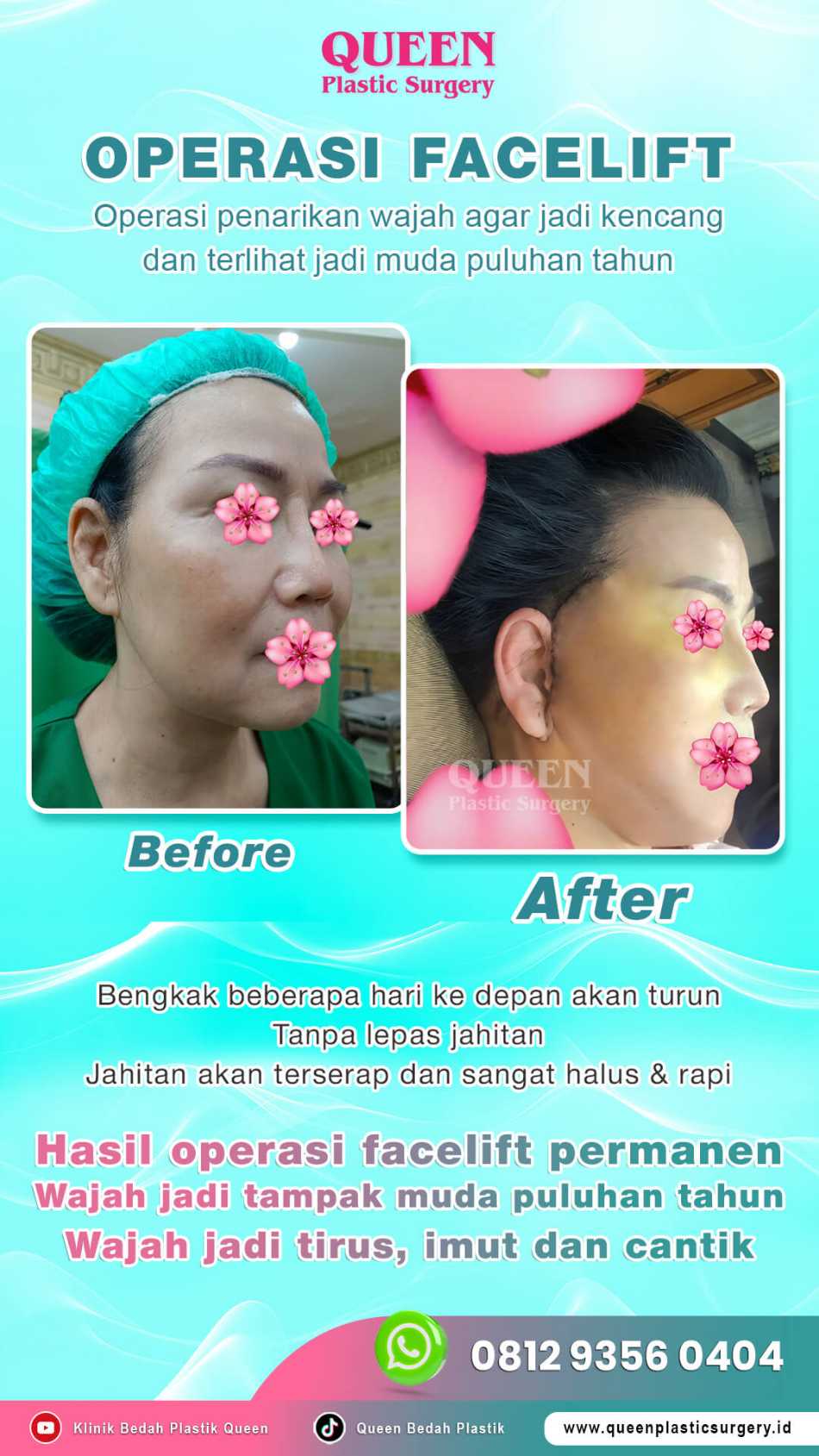 Menggabungkan Facelift Dan Transfer Lemak Wajah: Dapatkan Manfaatnya Untuk Wajah Kencang dan Bervolume Alami