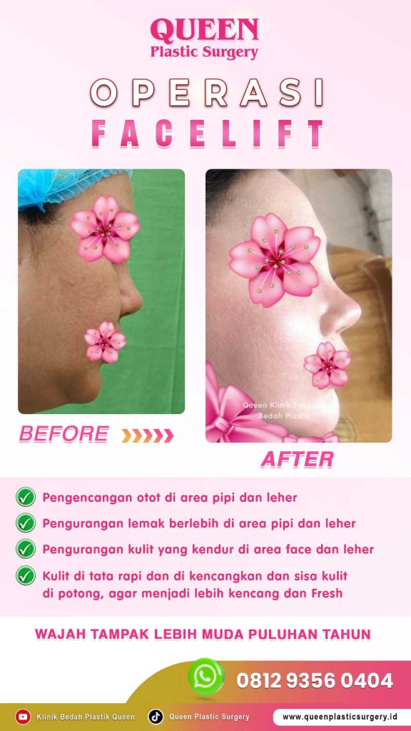 Hasil Maksimal! Keuntungan Menjalani Operasi Facelift dan Neck Lift Secara Bersamaan
