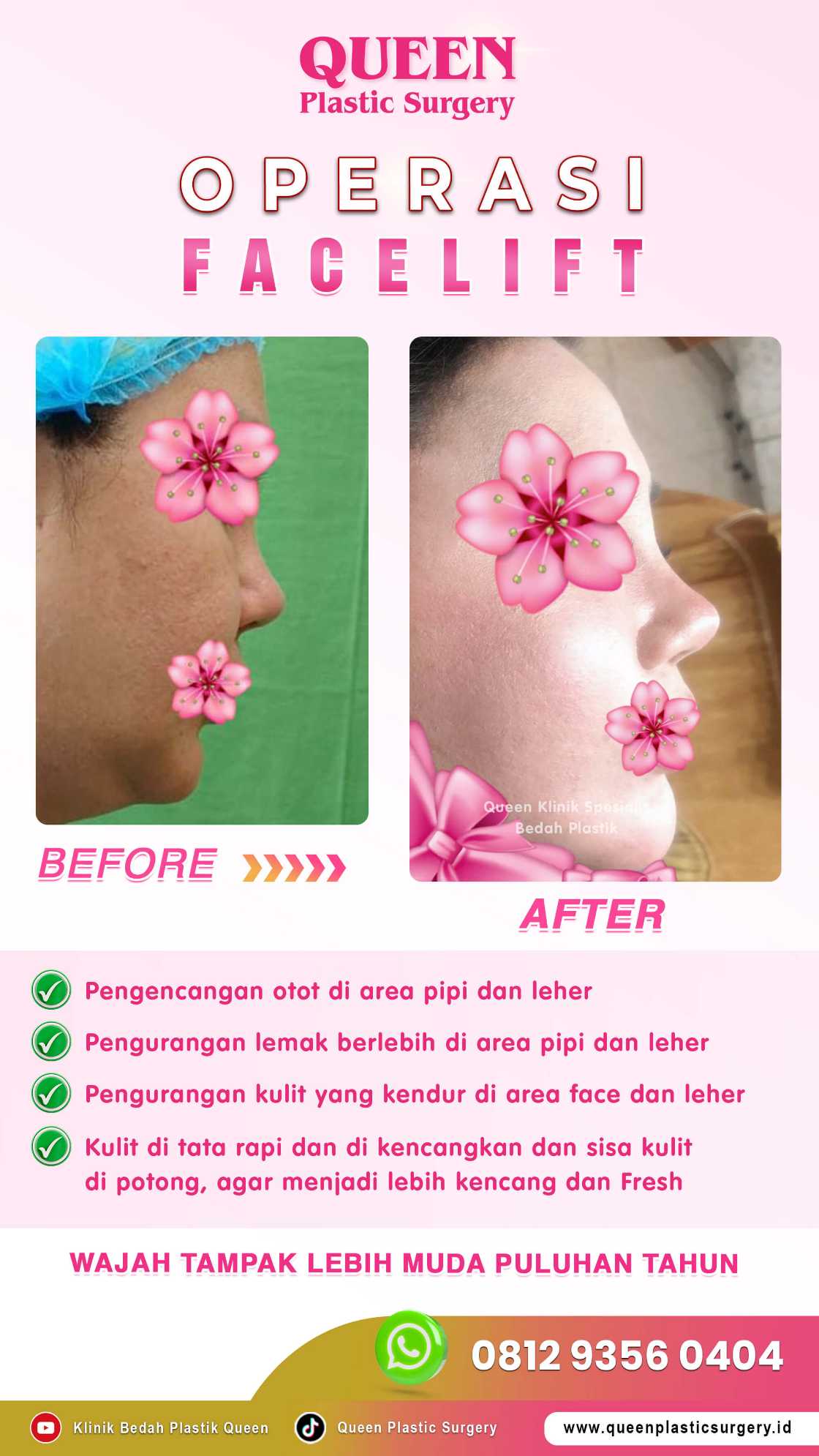 Kenali Tanda-Tanda Penuaan Wajah yang Paling Efektif Diatasi Dengan Mid Facelift