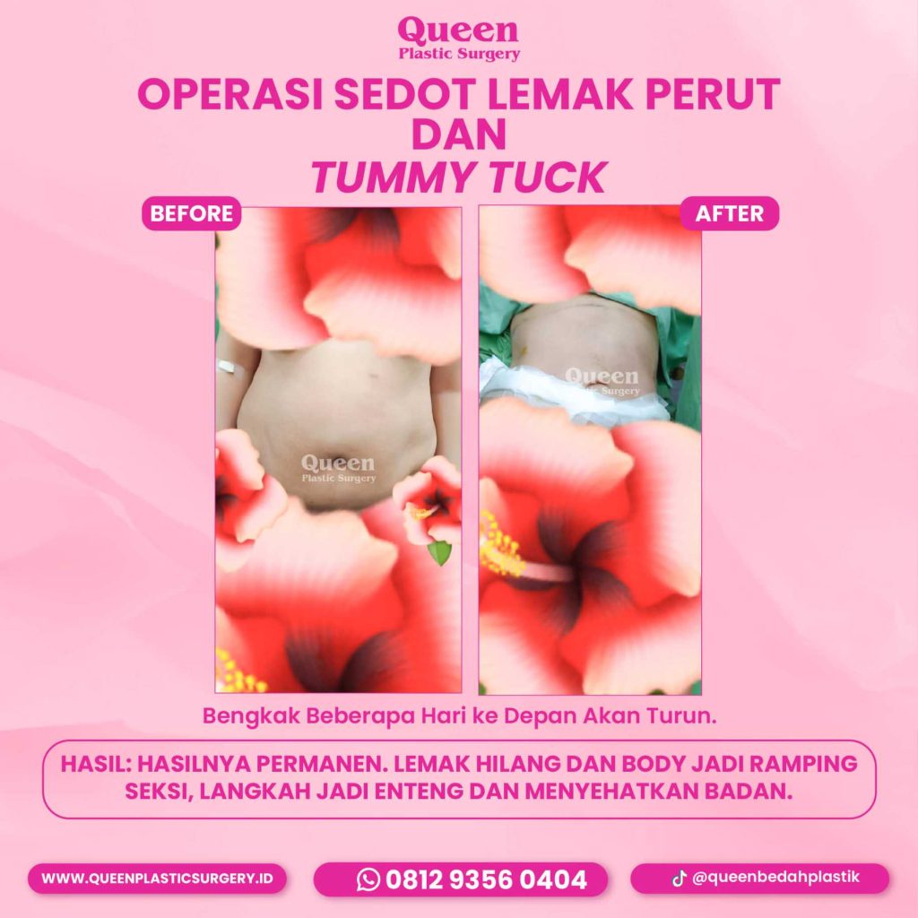 Di Mana Saja Transfer Lemak Bisa Dilakukan? Kenali Area Target Idealnya!
