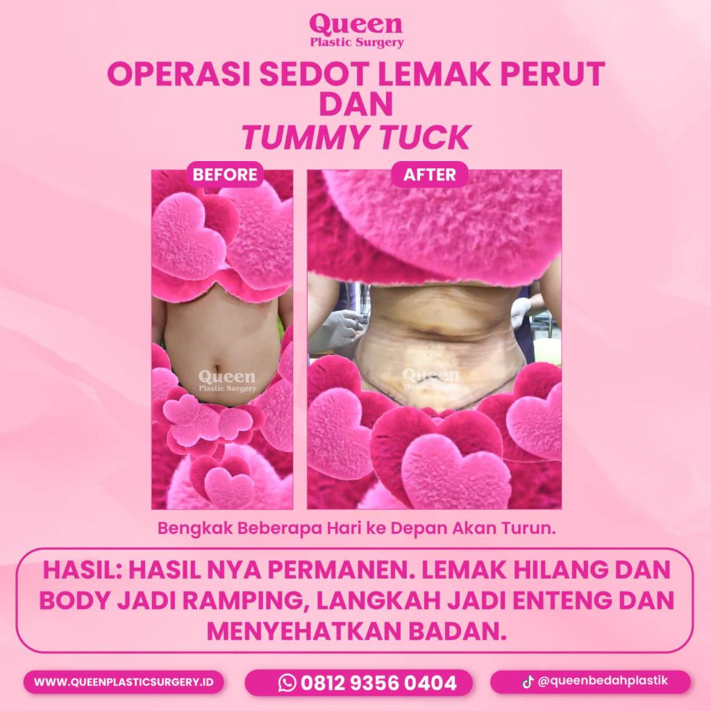 Di Mana Saja Transfer Lemak Bisa Dilakukan? Kenali Area Target Idealnya!