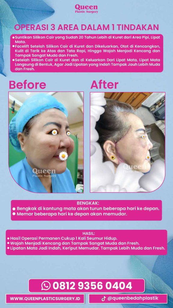Mengenal Manfaat Kombinasi untuk Wajah dan Leher Kencang Dengan Facelift dan Necklift