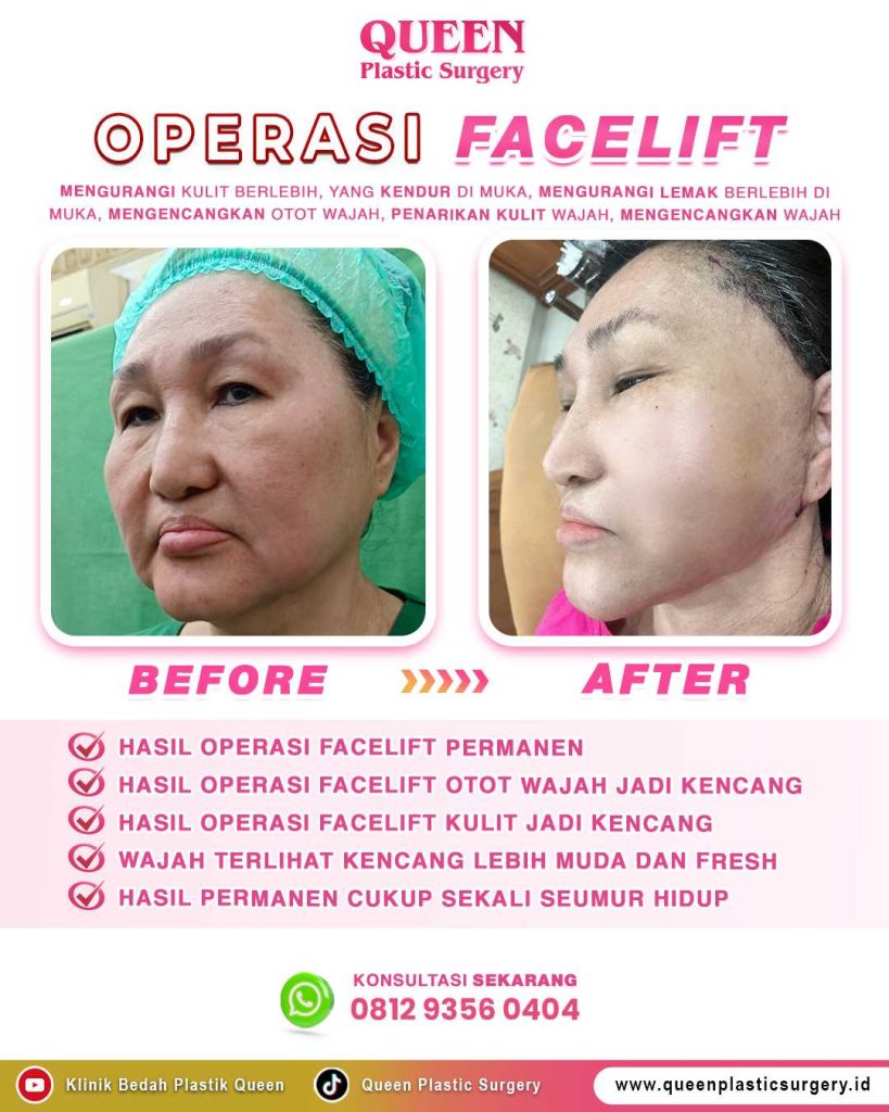 Mengapa Facelift dan Neck Lift Sering Dikombinasikan? Kelebihan & Kekurangan yang Wajib Anda Tahu