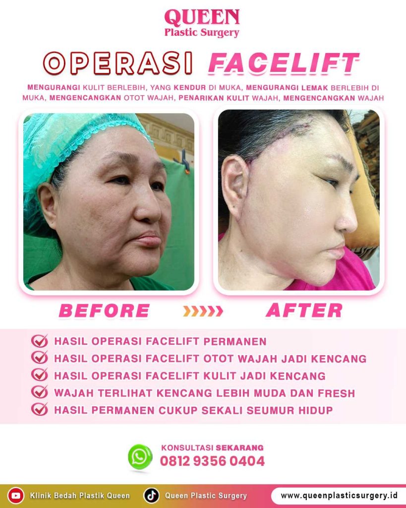 Mengapa Facelift dan Neck Lift Sering Dikombinasikan? Kelebihan & Kekurangan yang Wajib Anda Tahu
