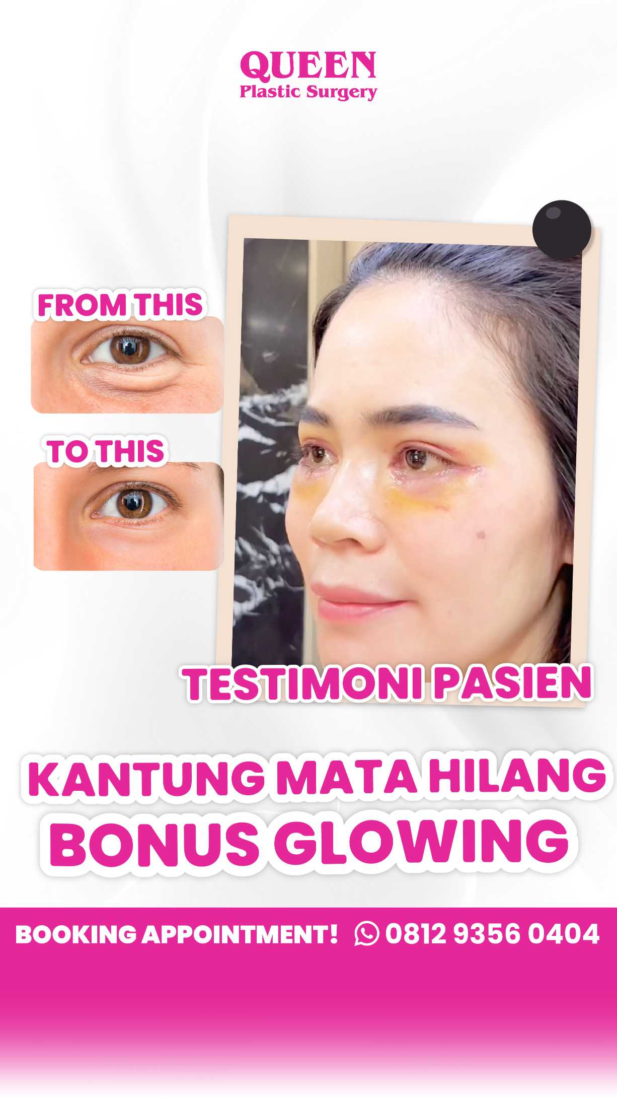 Pilih Mana? Pengangkatan Alis atau Blepharoplasty untuk Atasi Tanda Penuaan Mata?