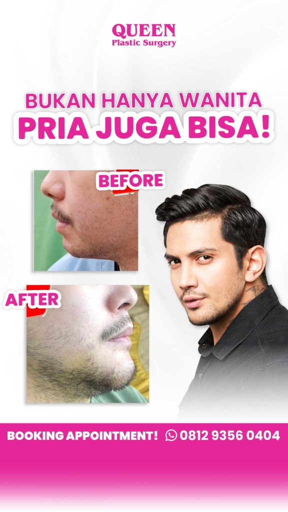 Dagu Ideal & Wajah Lebih Harmonis dengan Implan Dagu