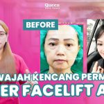 Mengenal Manfaat Kombinasi untuk Wajah dan Leher Kencang Dengan Facelift dan Necklift