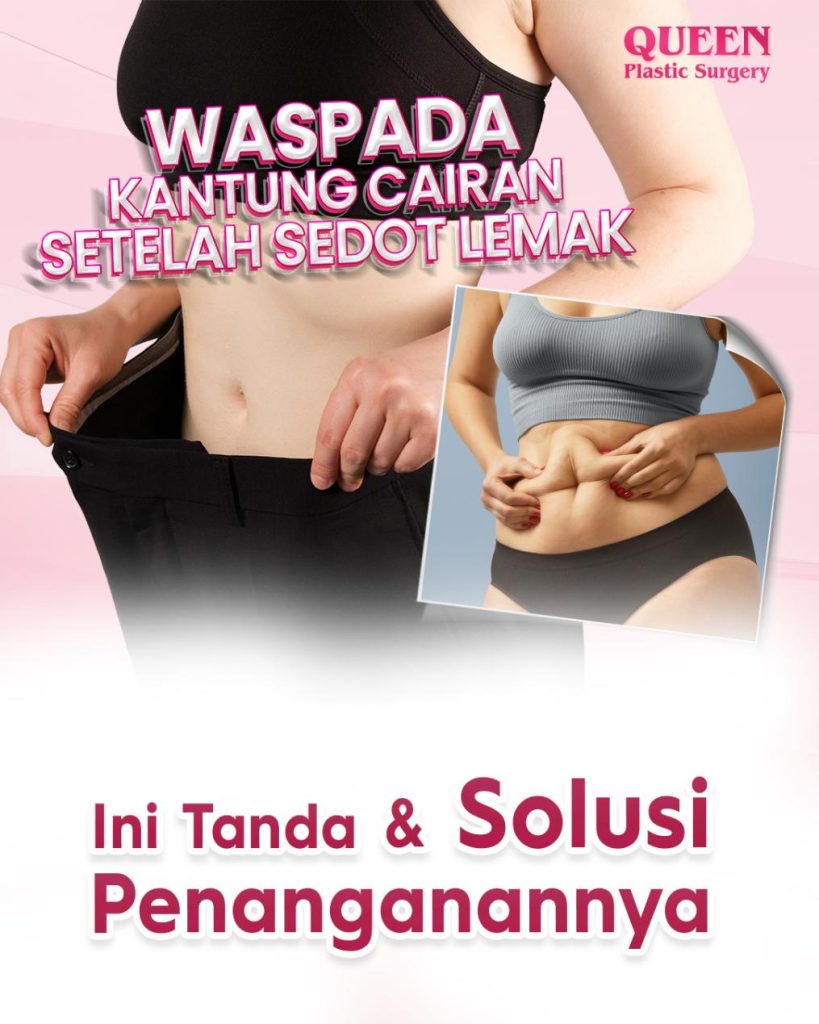 Waspada Kantung Cairan Seroma Setelah Sedot Lemak: Ini Tanda dan Solusi Penanganannya