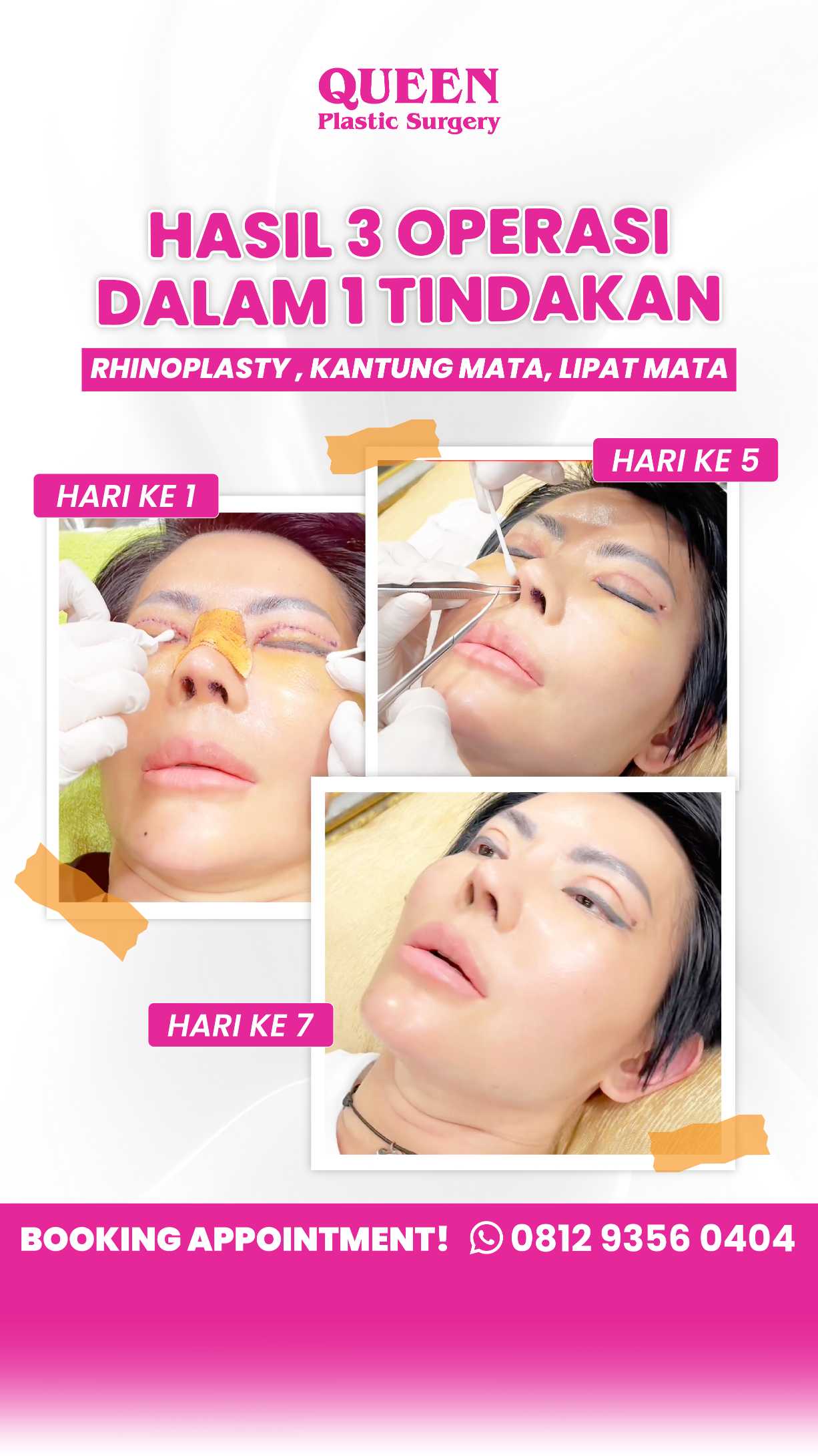 Rahasia Mata Indah Setelah Blepharoplasty: Ini Caranya Meminimalkan Tampilan Asimetri Kelopak Mata Anda