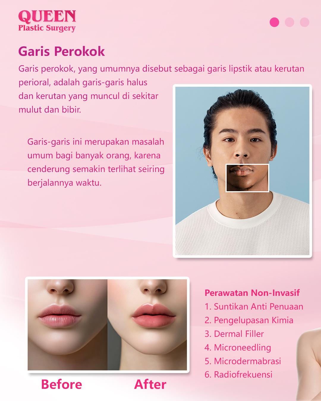 Garis Bibir Kerutan Akibat Merokok? Dapatkan Solusi Estetik Terbaik Pada Area Bibir dengan Operasi Plastik