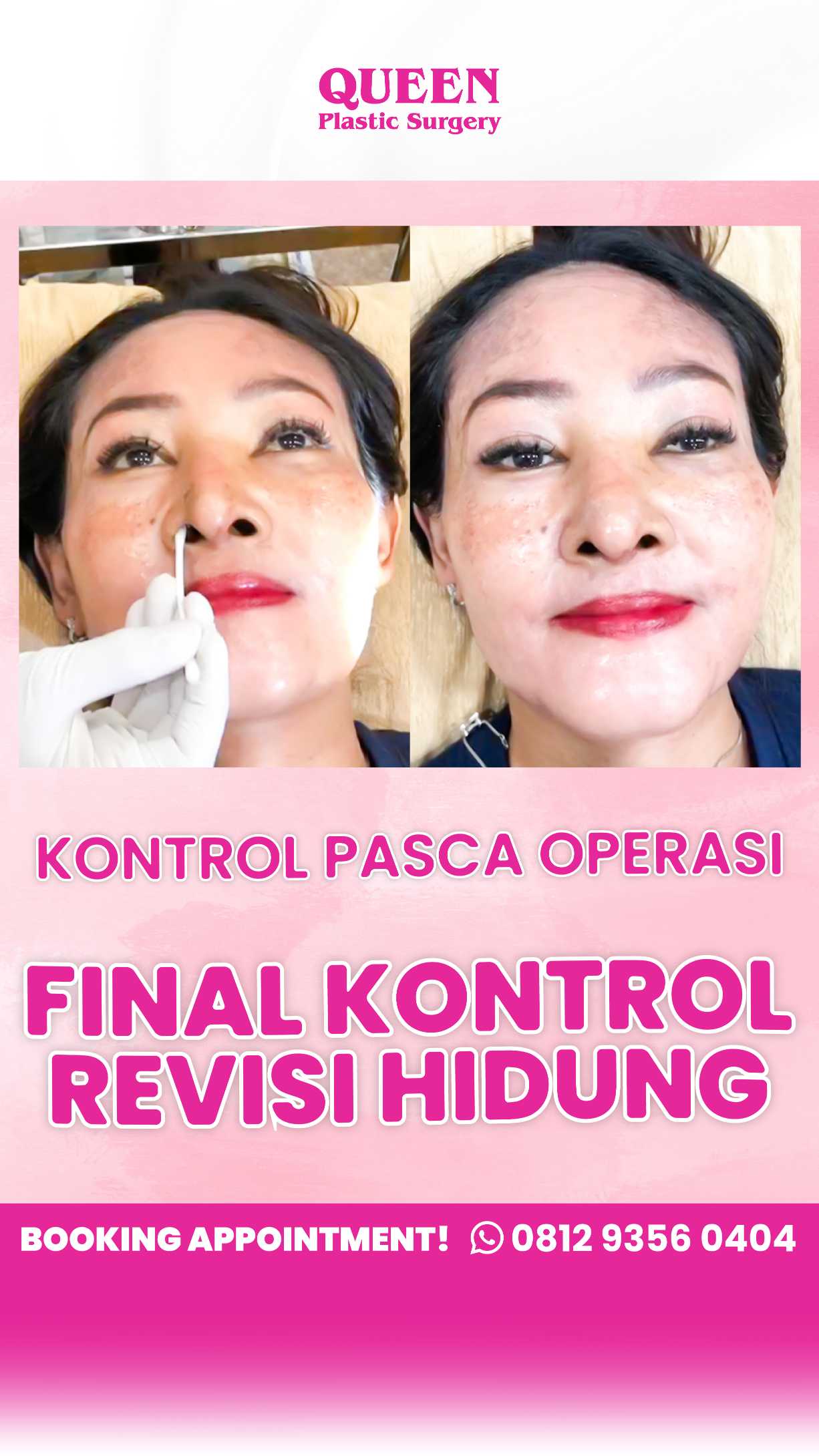Flu Dan Pilek Jelang Operasi Plastik? Ini yang Harus Anda Lakukan!