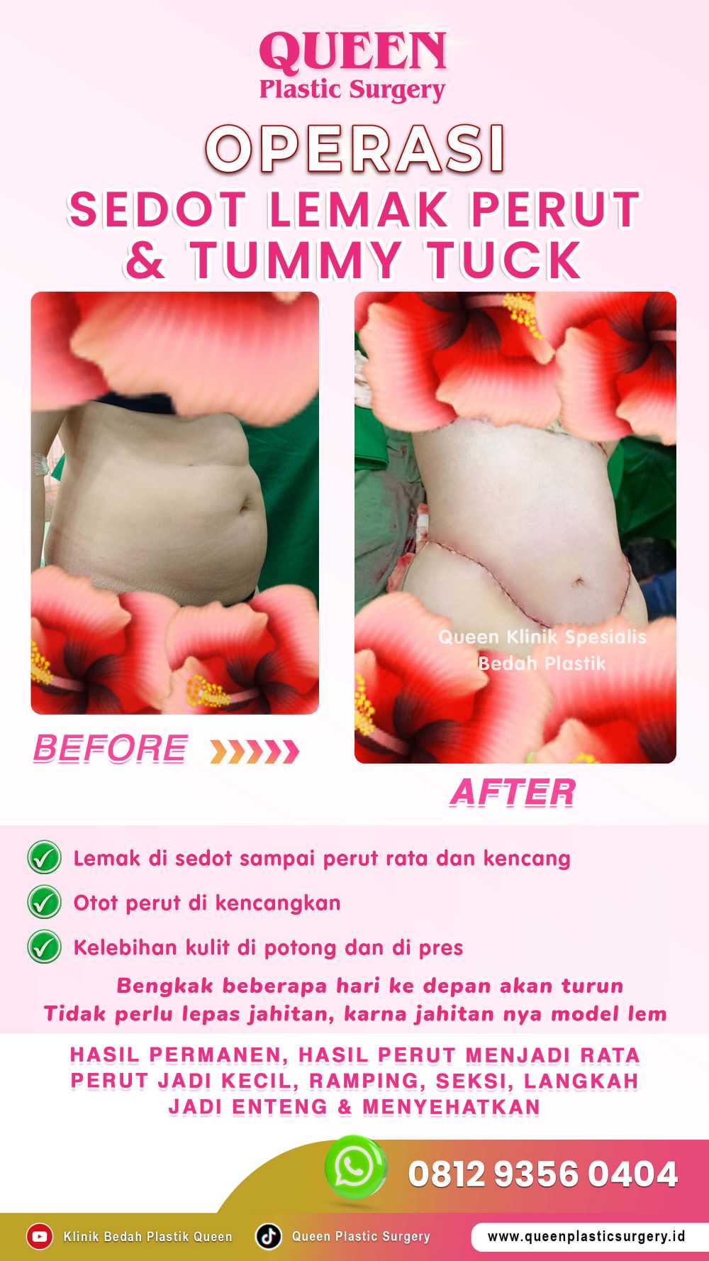 Waspada Kantung Cairan Seroma Setelah Sedot Lemak: Ini Tanda dan Solusi Penanganannya