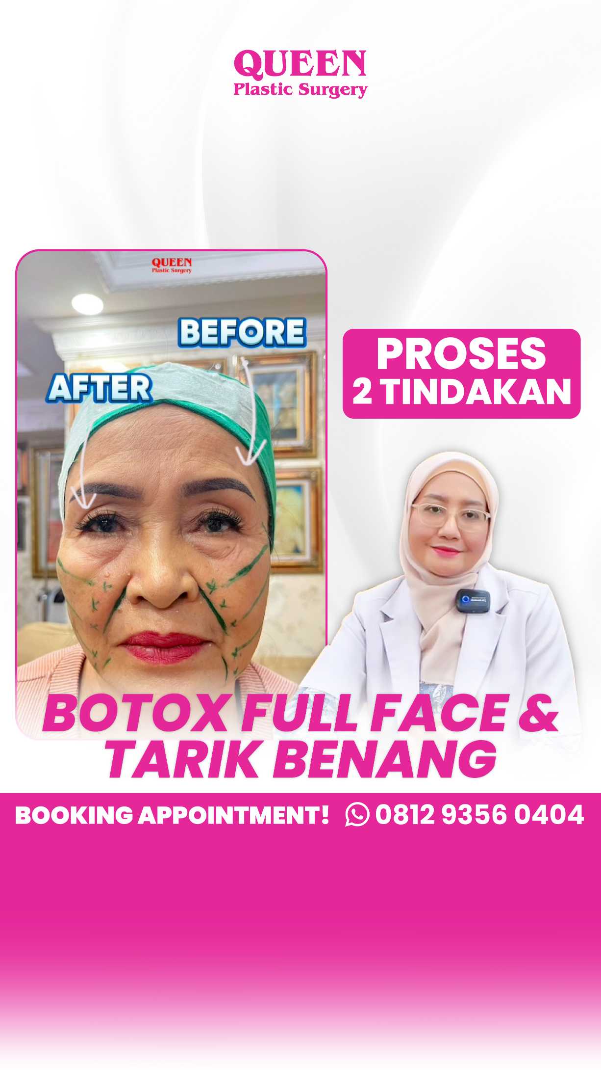 Bukan Hanya Filler, Botox Juga Bisa Bikin Hidung Lebih Ramping!