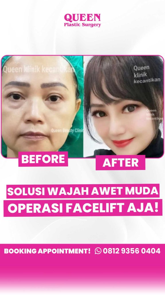 Mengapa Facelift dan Neck Lift Sering Dikombinasikan? Kelebihan & Kekurangan yang Wajib Anda Tahu