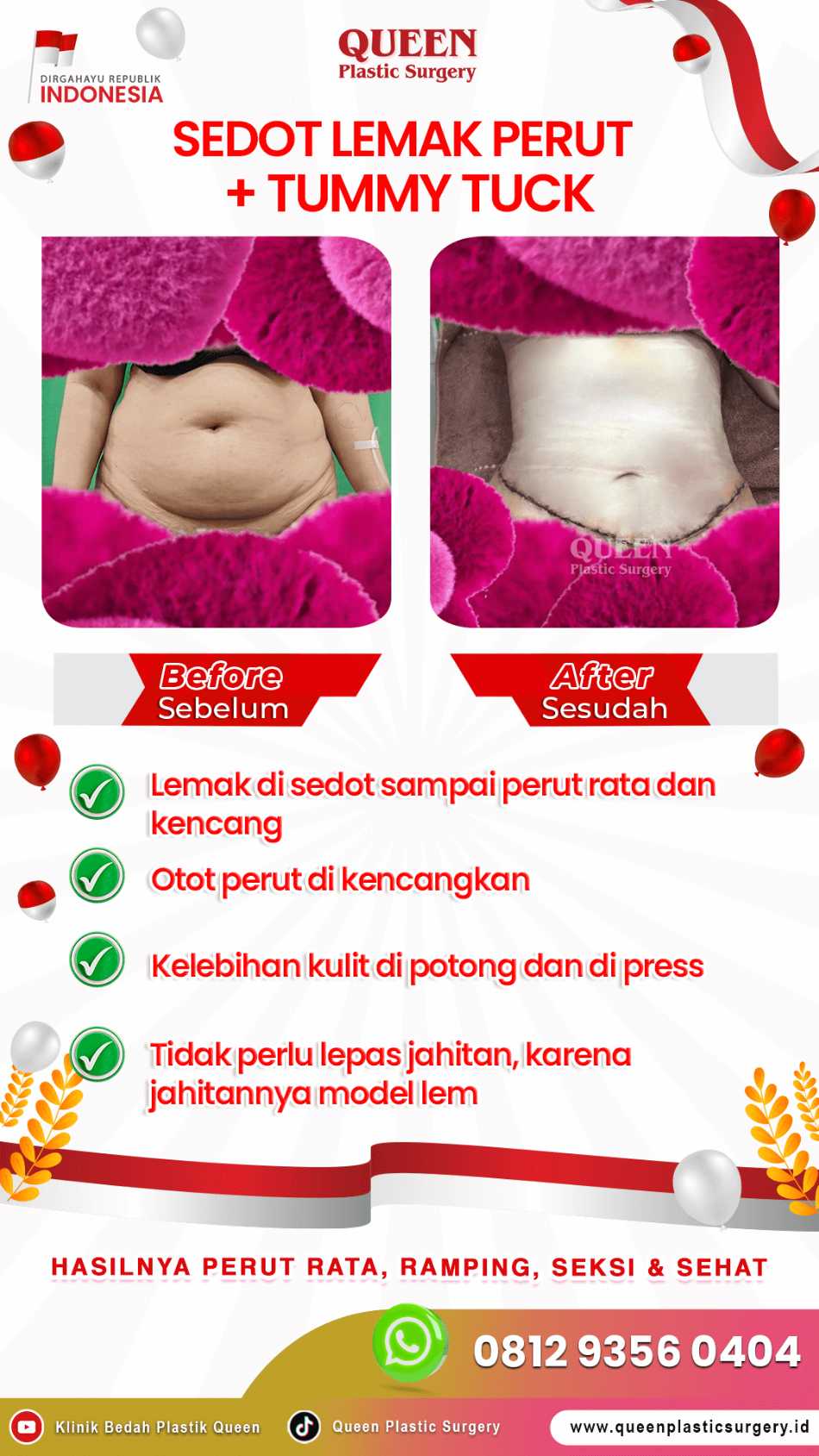 Waspada Kantung Cairan Seroma Setelah Sedot Lemak: Ini Tanda dan Solusi Penanganannya