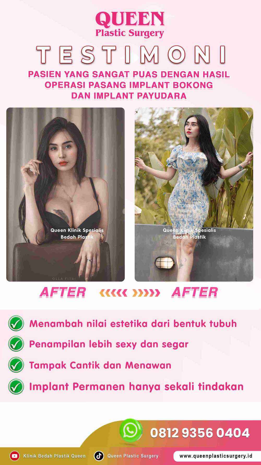 Fakta Keamanan Operasi Implan Bokong yang Wajib Anda Tahu
