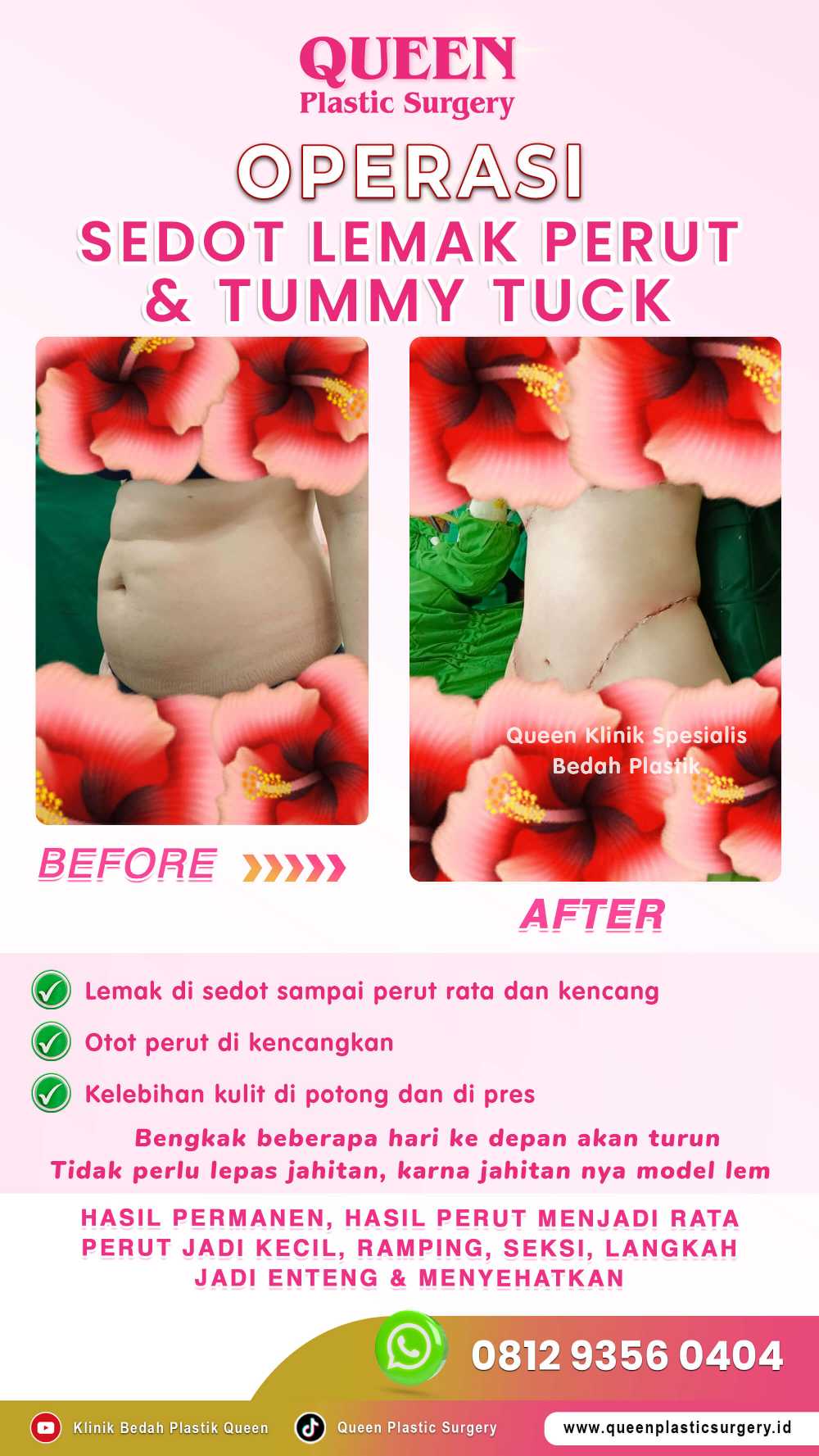 Waspada Kantung Cairan Seroma Setelah Sedot Lemak: Ini Tanda dan Solusi Penanganannya